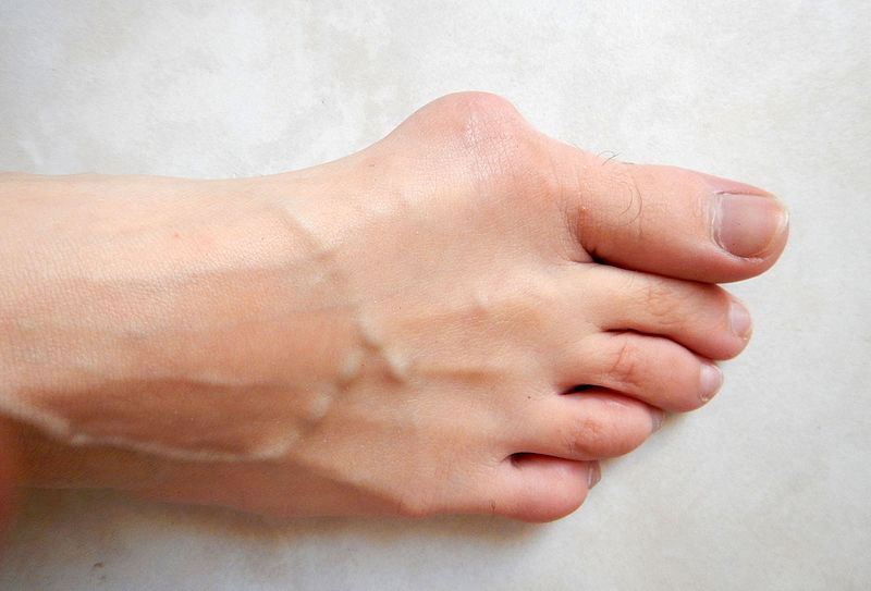 Blasted Bunions